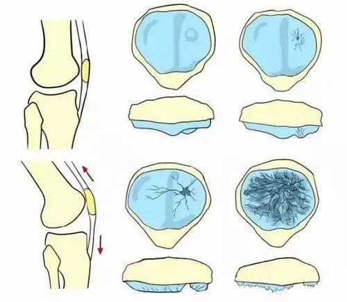 跑步膝蓋疼后還能跑嗎_跑步后膝蓋痛缺什么_膝蓋缺痛跑步后更痛