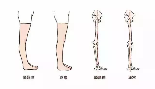 腳踝痛還繼續(xù)運(yùn)動(dòng)會(huì)怎么樣_運(yùn)動(dòng)后腳踝疼 多久能好_疼腳踝能運(yùn)動(dòng)好后會(huì)疼嗎