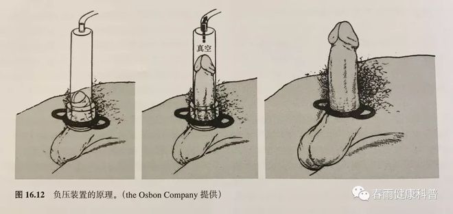 真空沒(méi)有空氣嗎_真空鍛煉器有沒(méi)有用_真空鍛煉有用嗎