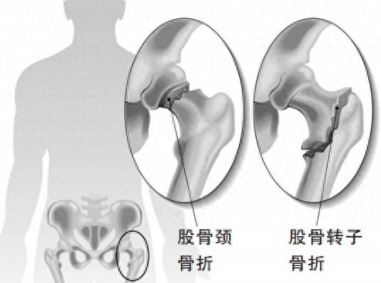 pg電子賞金試玩app 涉及20萬人的研究發(fā)現(xiàn)：10月，老人最容易跌倒