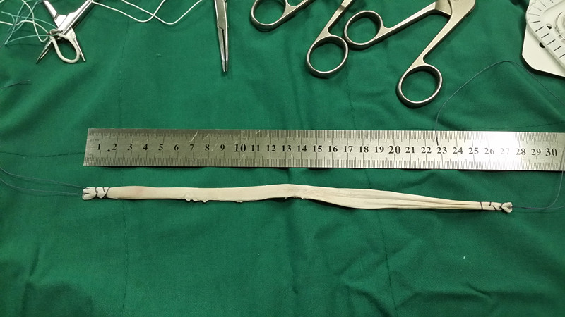 pg電子賞金試玩app 前交叉韌帶重建手術(shù)，用什么材料比較好？自體、異體還是人工韌帶